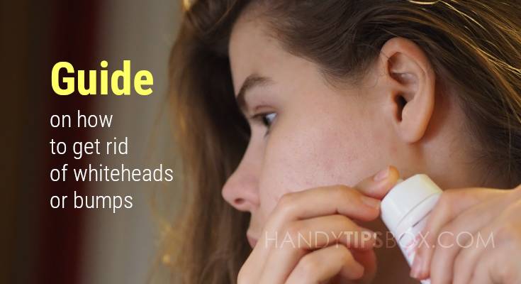 Guide on how to get rid of whiteheads or bumps