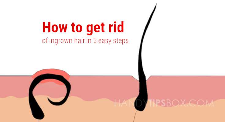 How to get rid of ingrown hair in 5 easy steps