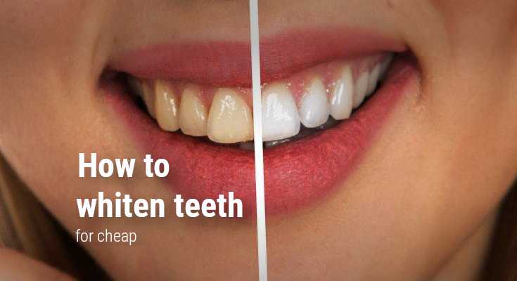 How to whiten teeth for cheap: best teeth whitening kit